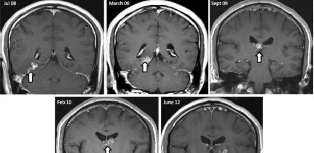 Homem vai ao médico com dor de cabeça e descobre parasita raro no cérebro