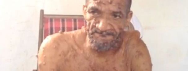 Homem com o corpo coberto de verrugas pede ajuda para tratamento