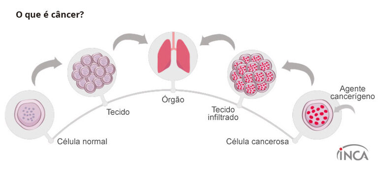 Estudo investiga como começa e evolui o câncer de esôfago