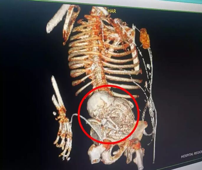 “Grávida por 5 décadas”: paciente descobre feto mumificado há 56 anos no útero